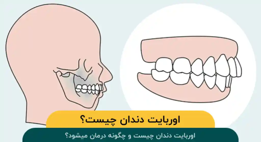 اوربایت-دندان